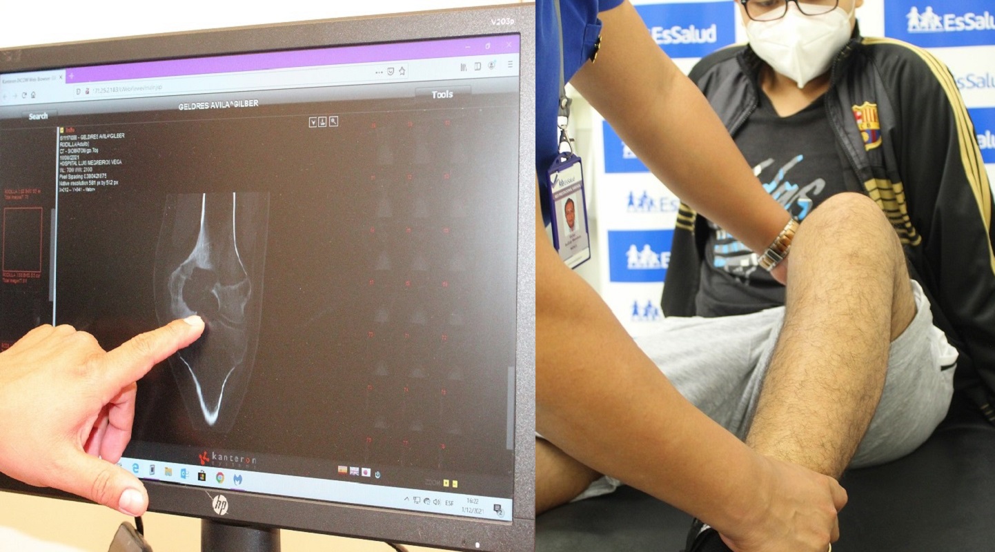 Jóven estudiante de 14 años de edad salva pierna gracias a exitoso trasplante de cabeza de fémur, realizado por EsSalud.